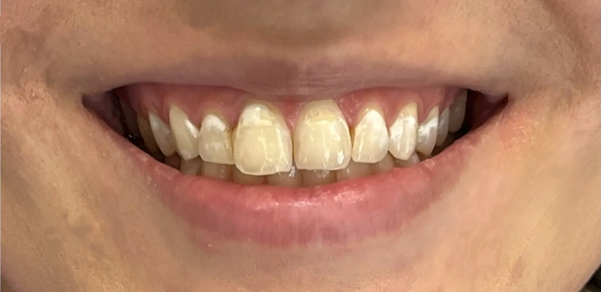 Przed leczeniem - pacjent 1