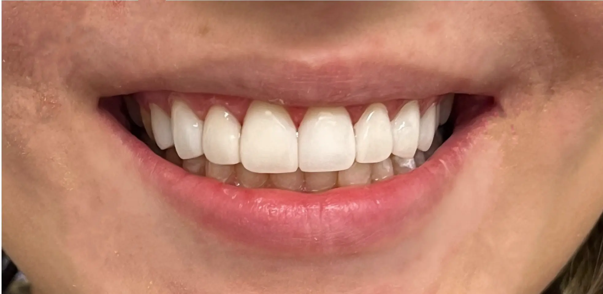 Po leczeniu - pacjent 1