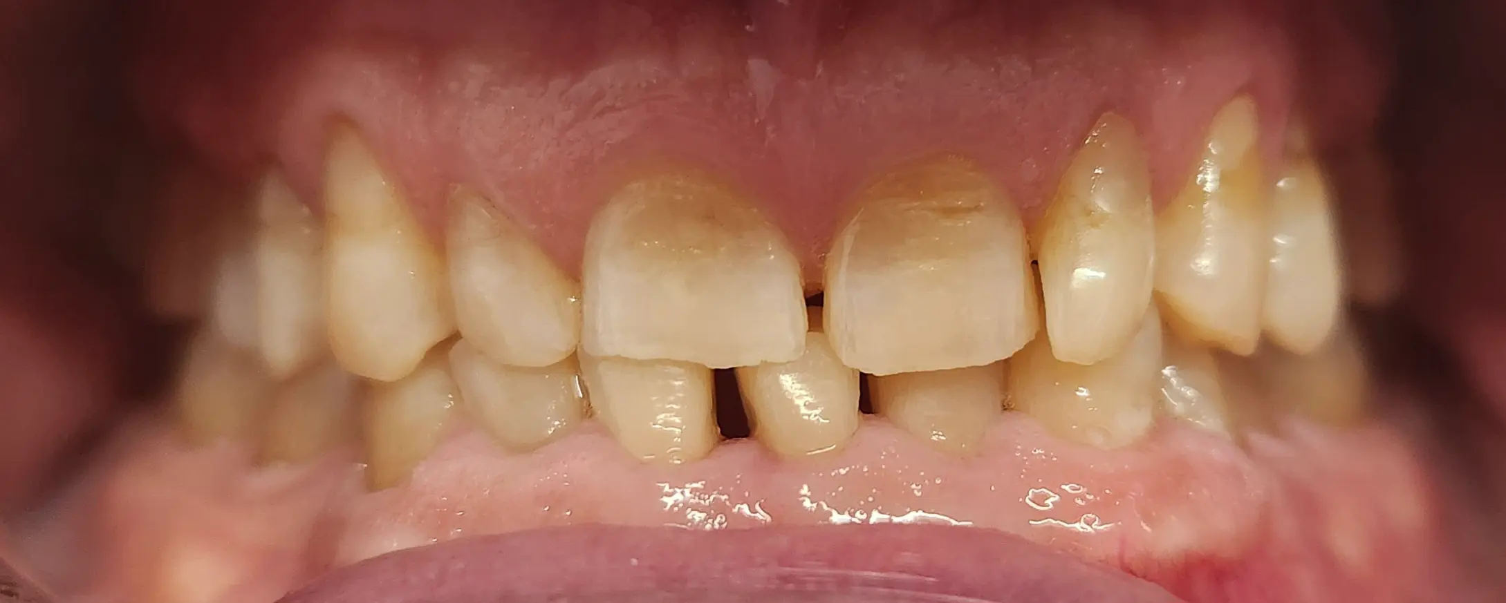 Przed leczeniem - pacjent 2