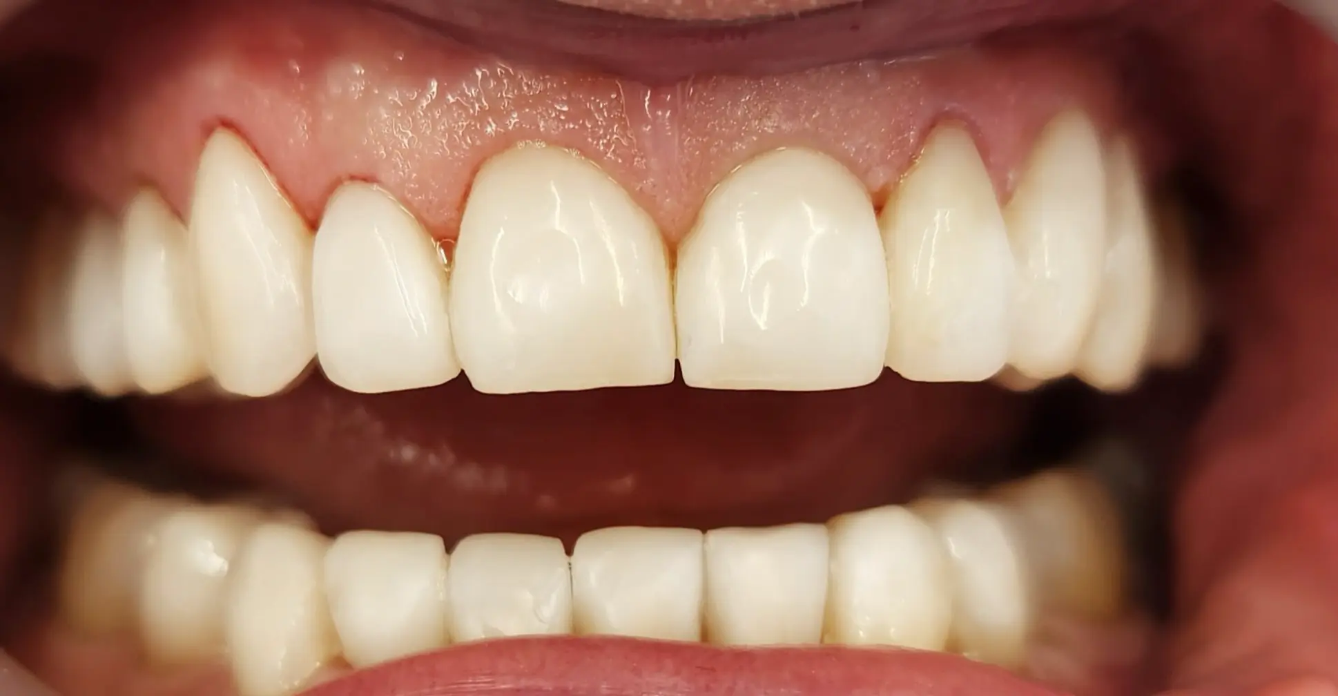 Po leczeniu - pacjent 2