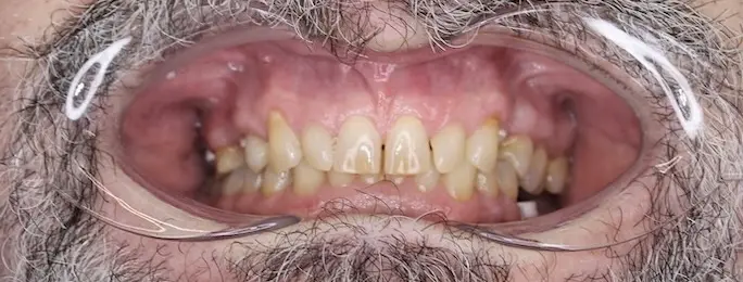 Przed leczeniem - pacjent 3