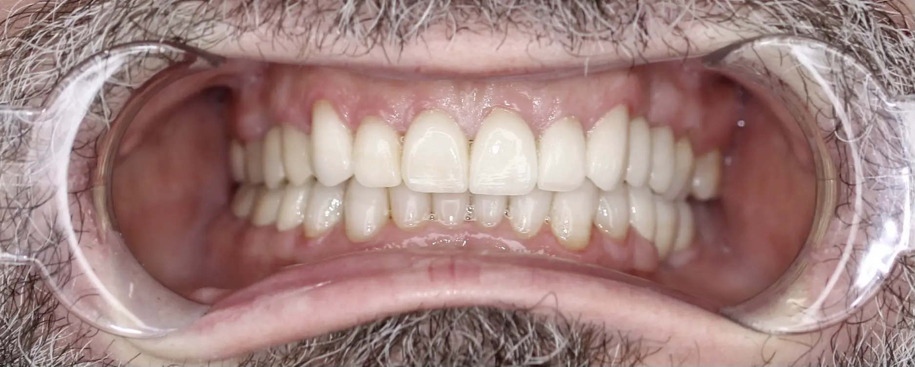 Po leczeniu - pacjent 3