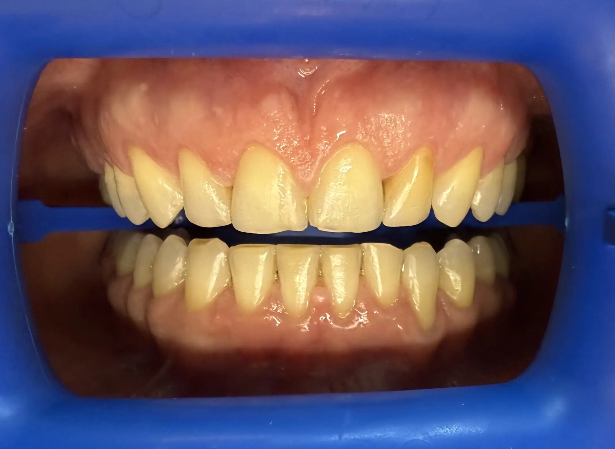 Przed leczeniem - pacjent 4