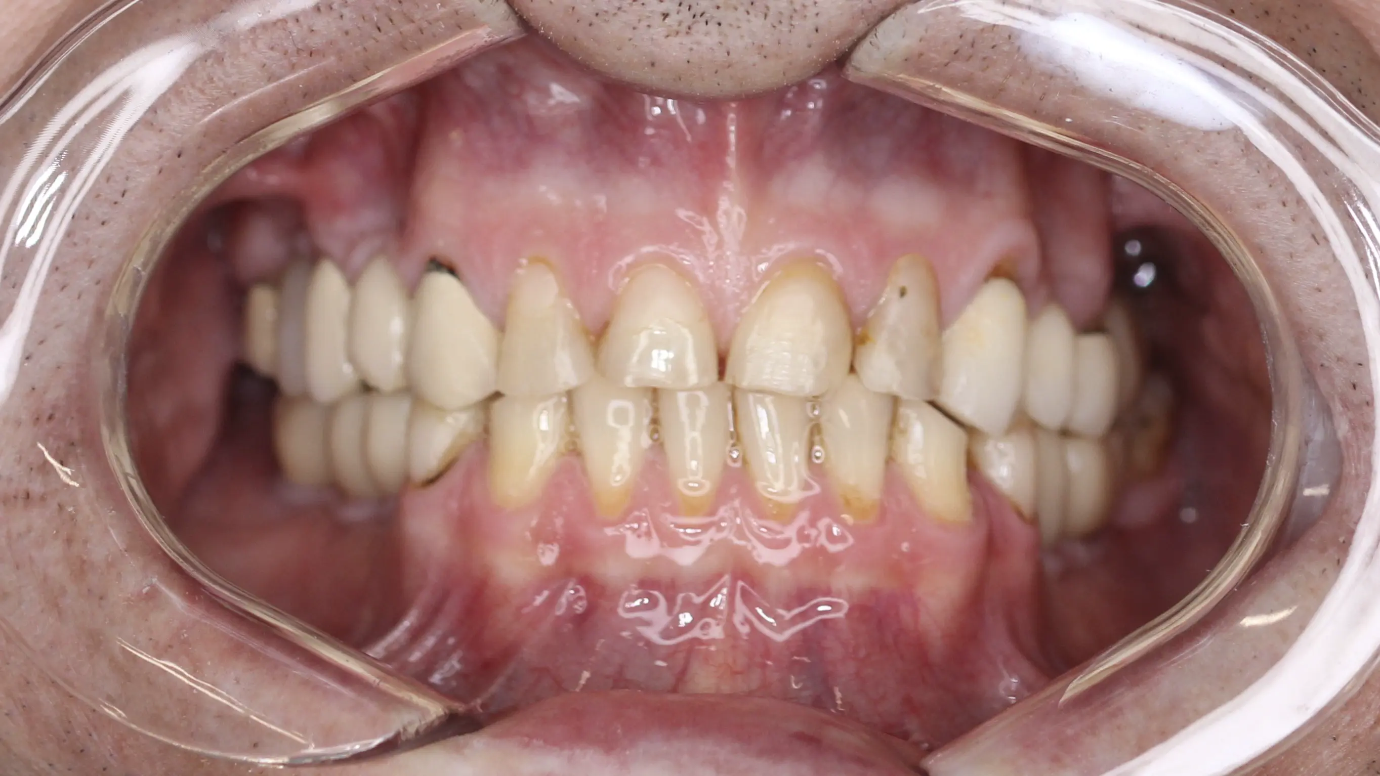 Przed leczeniem - pacjent 5
