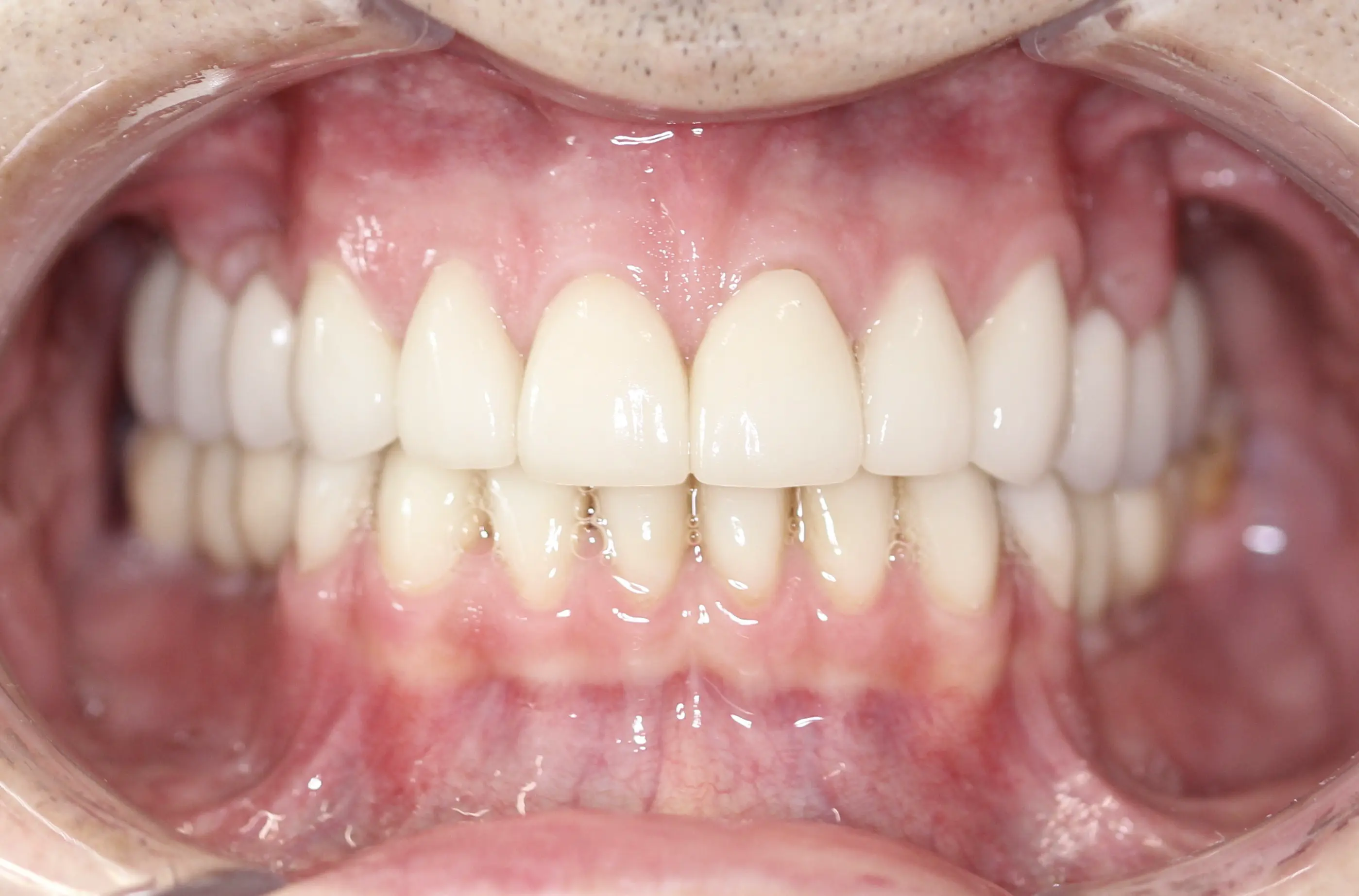 Po leczeniu - pacjent 5