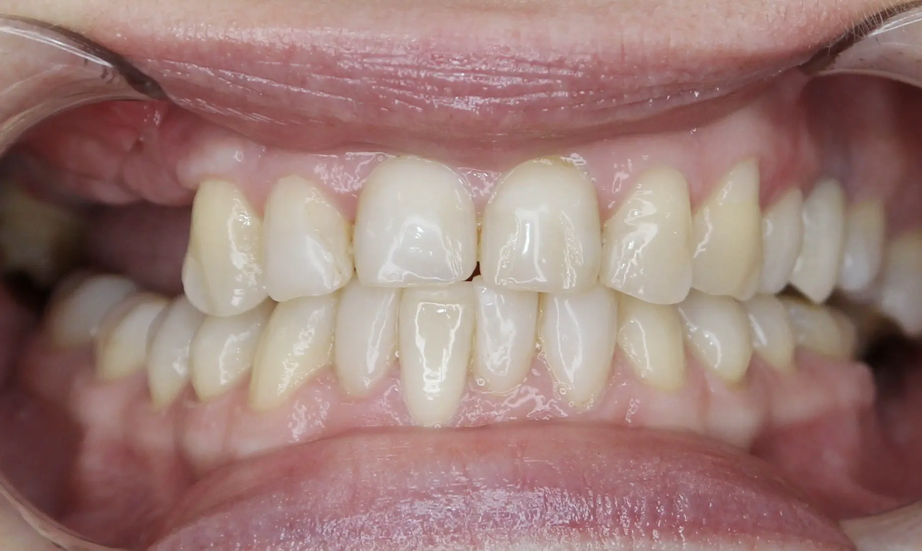 Przed leczeniem - pacjent 6