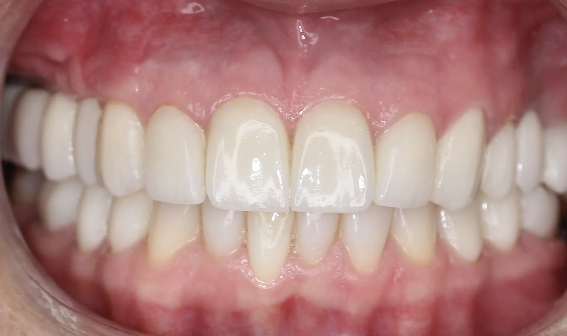 Po leczeniu - pacjent 6